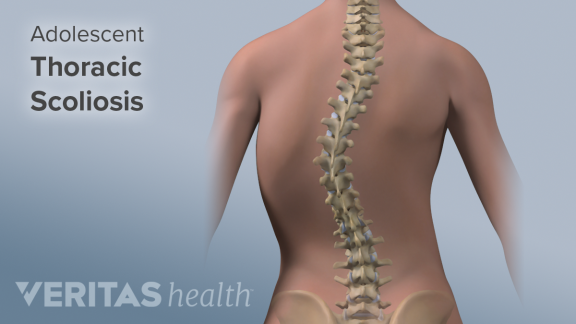 Things to Know About Scoliosis